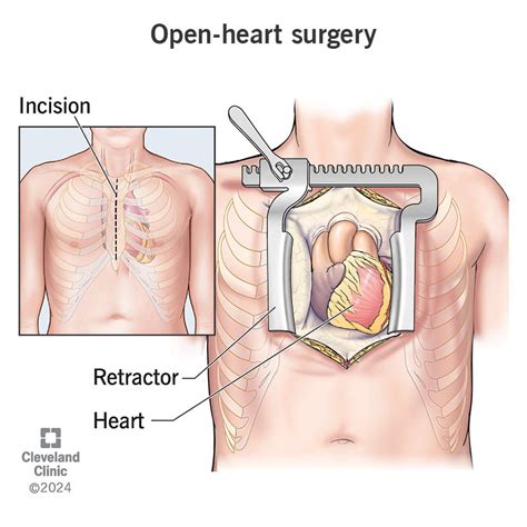 A Heartfelt Guide: What I Wish I Knew Before Open-Heart Surgery